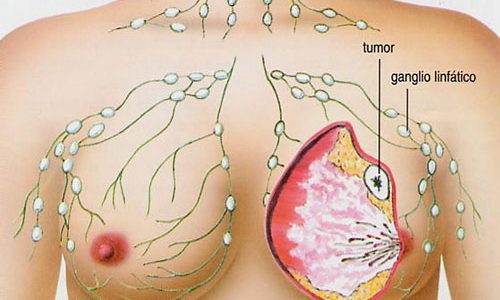 Cáncer de mama