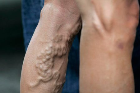 Varices