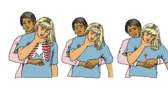 Maniobra de Heimlich