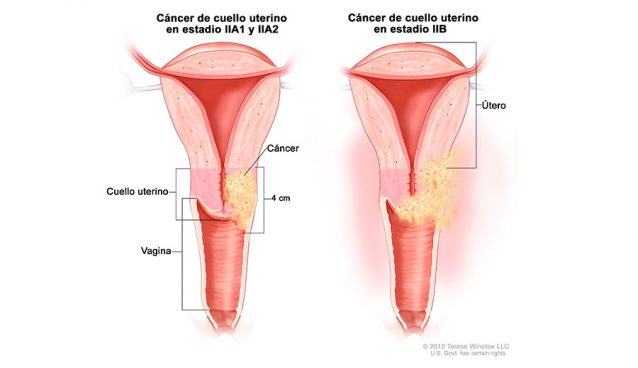 Cáncer de cuello uterino