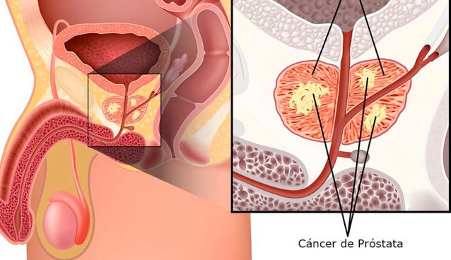Cáncer de Próstata