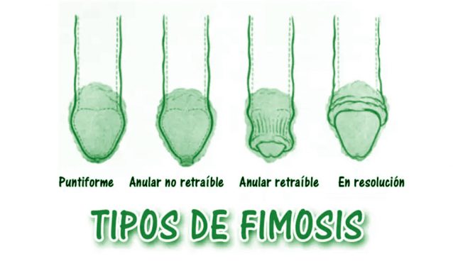 Tipos de fimosis