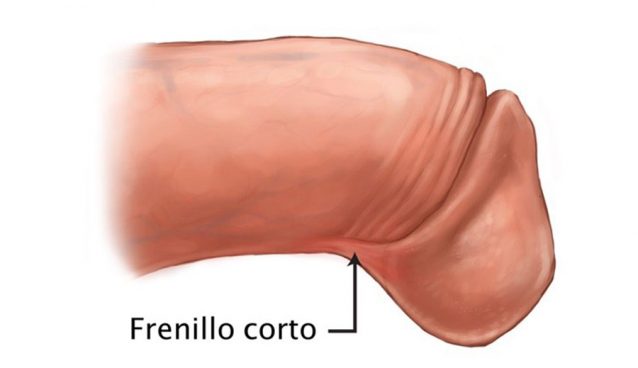 Frenillo corto