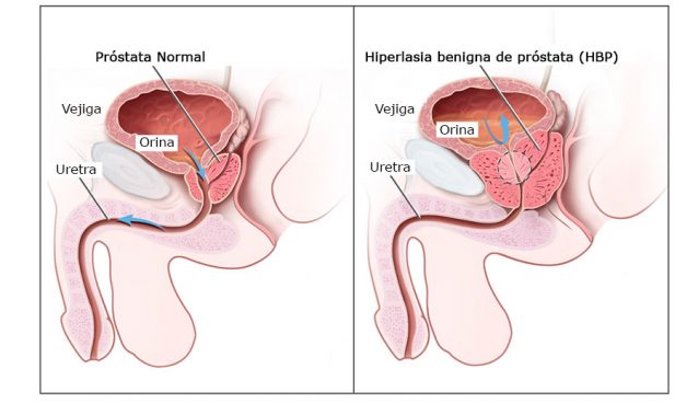 Hiperlasia benigna de próstata (HBP) o adenoma de próstata