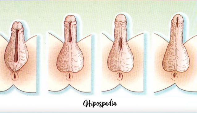 Hipospadia