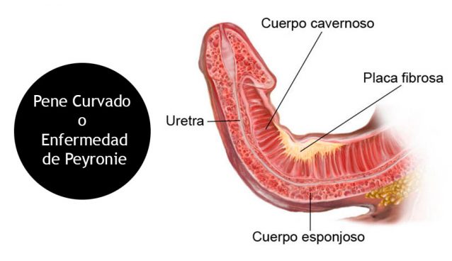 Pene curvado o enfermedad de Peyronie