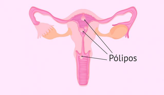 Pólipos uterinos