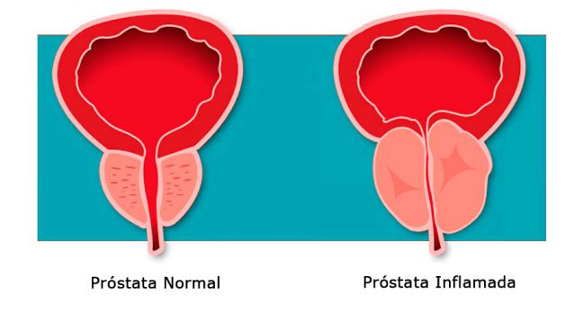 Prostatitis