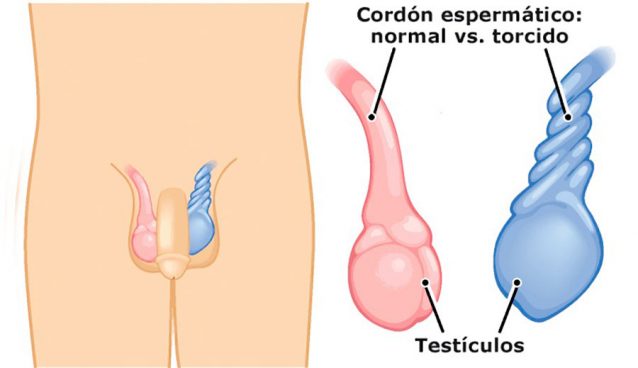 Torsión de testículo