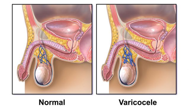 Varicocele
