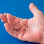 Contractura de Dupuytren